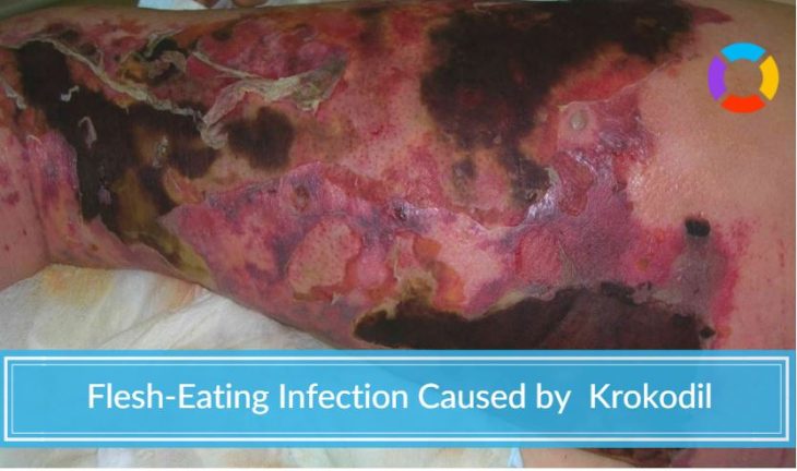 krokodil induced flesh infection