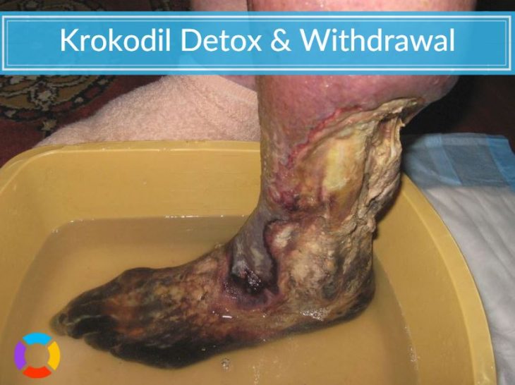 infected foot after krokodil use